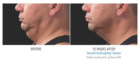 coolsculpting gold coast|Surrey CoolSculpting® w/ Cost Info .